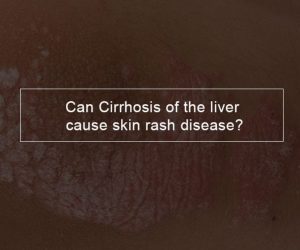 Can Cirrhosis of the liver cause skin rash disease