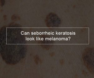 Can seborrheic keratosis look like melanoma