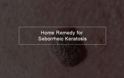 Home remedy for seborrheic keratosis