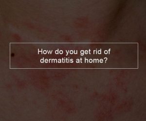 How do you get rid of dermatitis at home