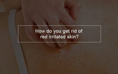 How do you get rid of red irritated skin