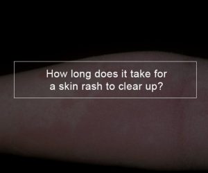 How long does it take for a skin rash to clear up