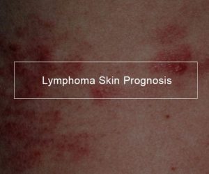 Lymphoma skin prognosis