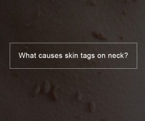 What causes skin tags on neck