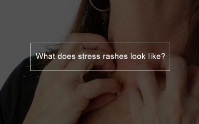 What does stress rashes look like